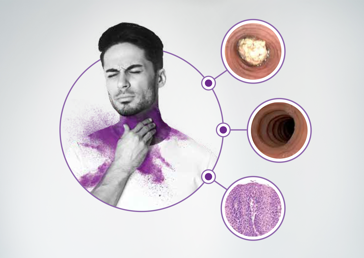 icon resources EoE: Understanding the Pathophysiology of Type 2 Inflammation and Disease Burden